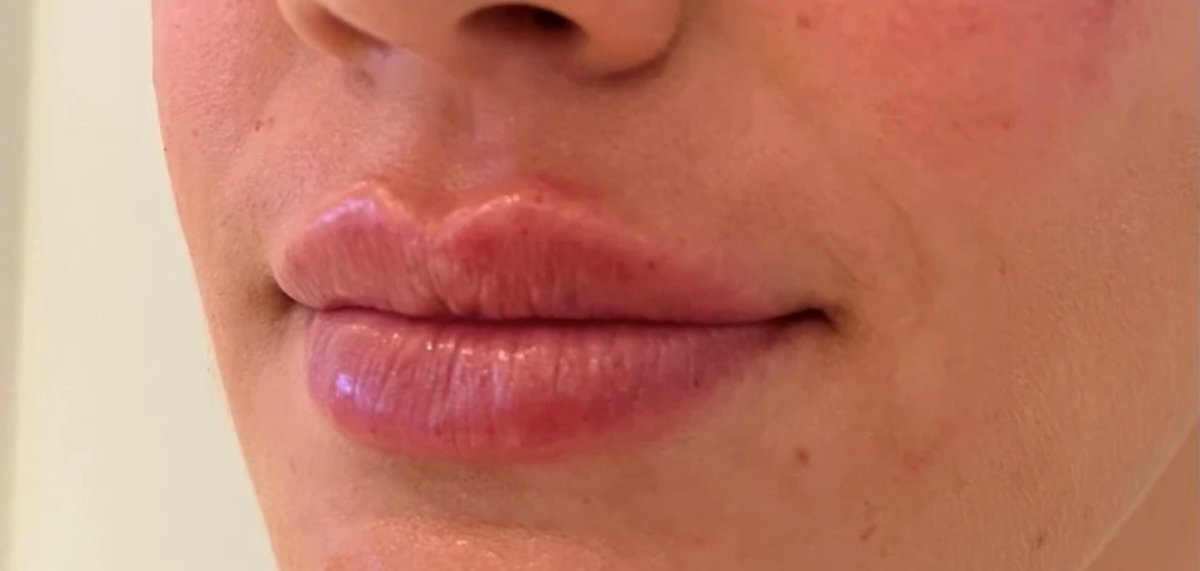 Body Lounge Park Cities Expands Aesthetic Services with Advanced Botox Treatments